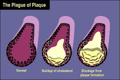 Cholesterol build-up in arteries progressively from left to right