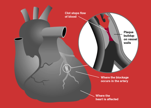 Diagram depicting how high cholesterol can cause a heart attack to occur